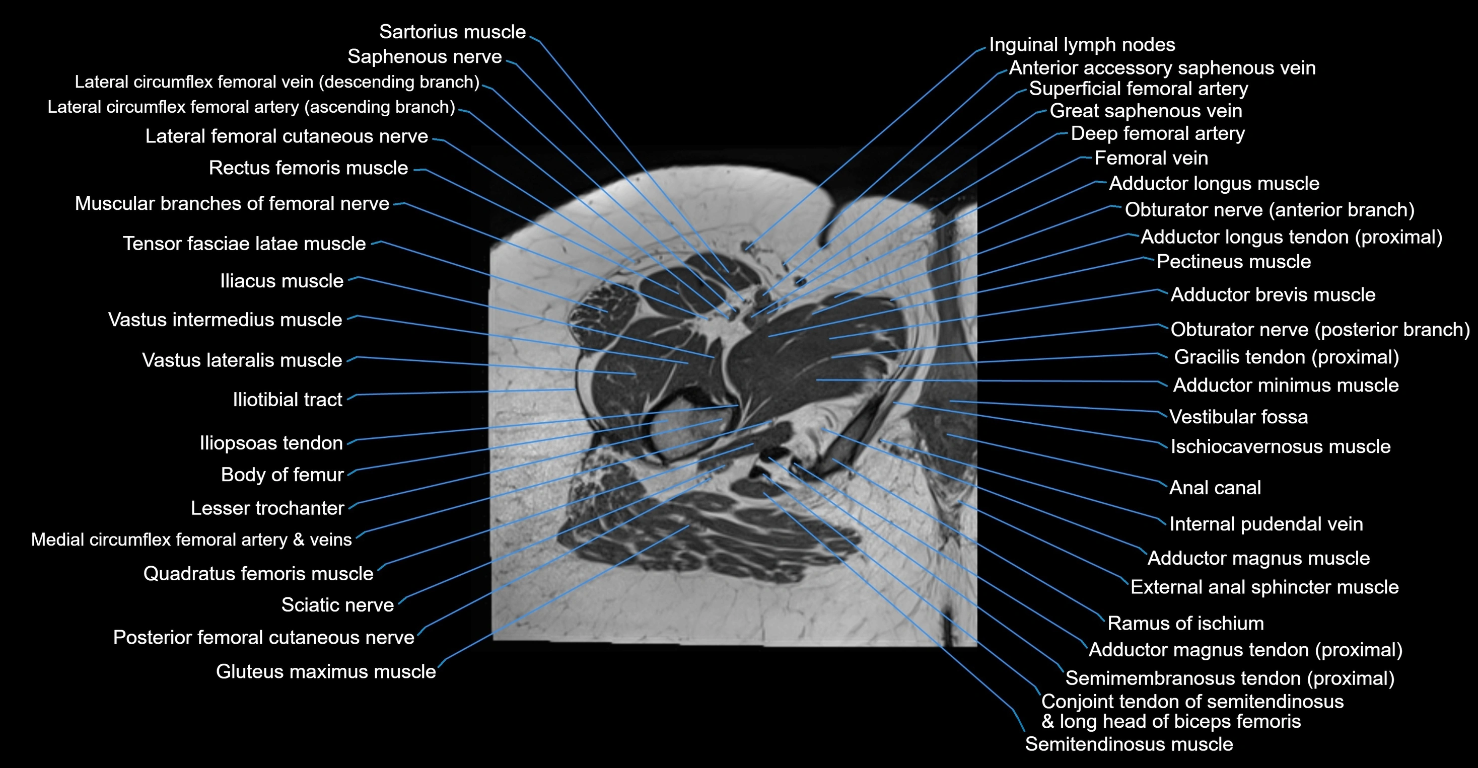 MRI hip axial cross sectional anatomy 3T 3D  radiology  anatomy image-img-00001-00068.webp